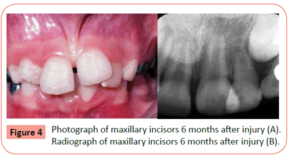 orthodontics-endodontics-maxillary-incisors-months