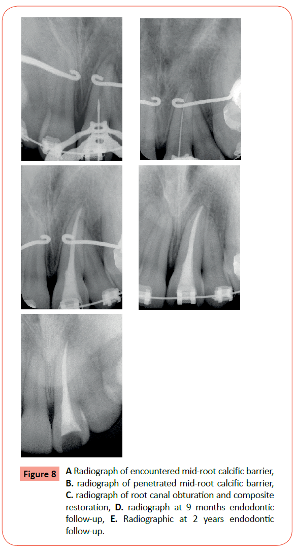 orthodontics-endodontics-mid-root-calcific