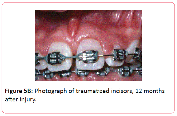 orthodontics-endodontics-months-after-injury