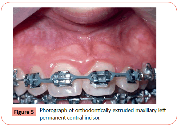 orthodontics-endodontics-orthodontically-extruded
