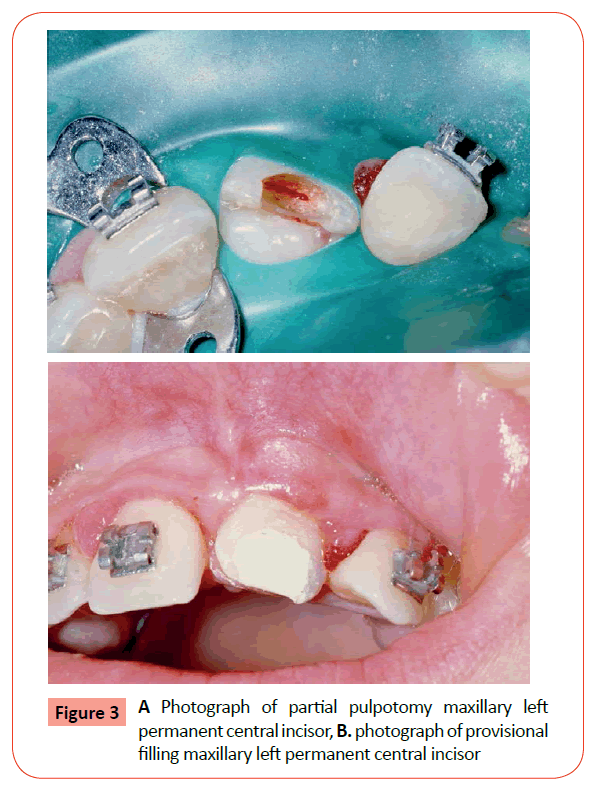 orthodontics-endodontics-partial-pulpotomy-maxillary
