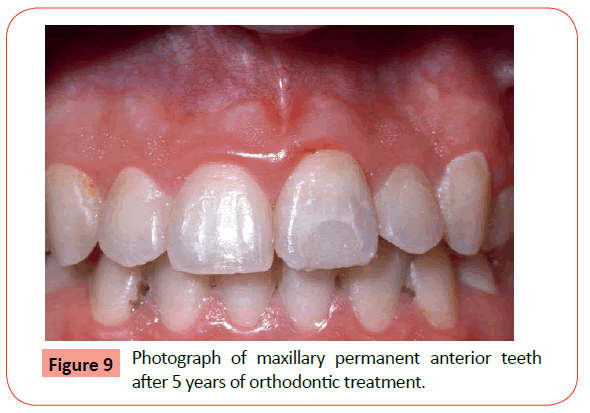 orthodontics-endodontics-permanent-anterior-teeth