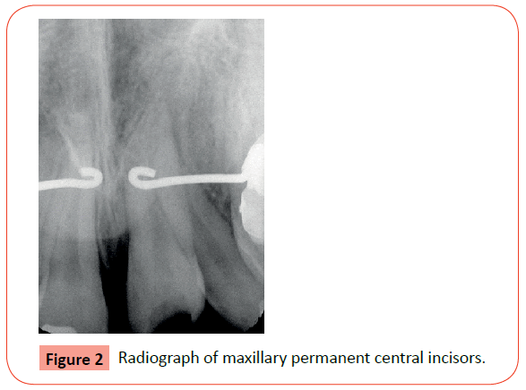 orthodontics-endodontics-permanent-central-incisors