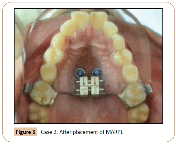 orthodontics-endodontics-placement-MARPE