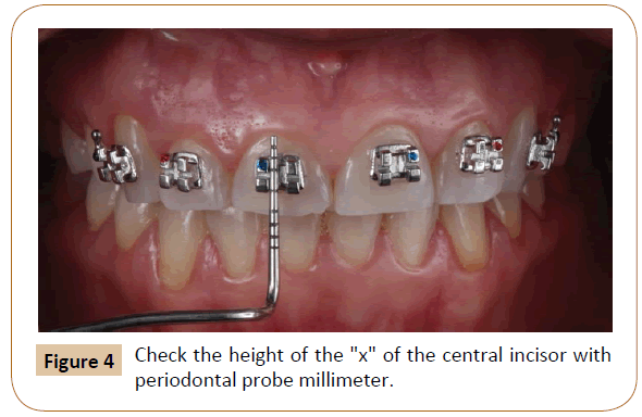 orthodontics-endodontics-probe-millimeter