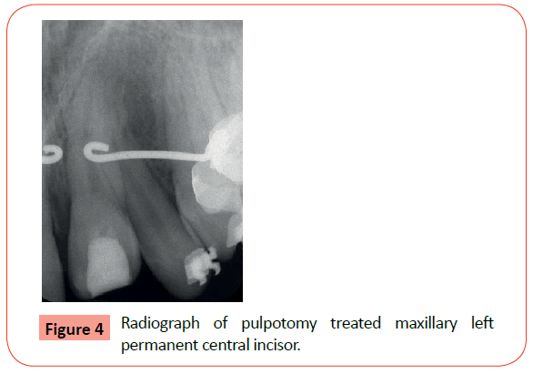 orthodontics-endodontics-pulpotomy-treated-maxillary