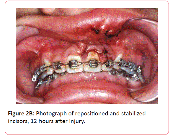 orthodontics-endodontics-repositioned-stabilized