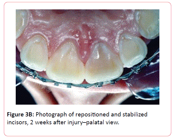 orthodontics-endodontics-repositioned-stabilized-incisors