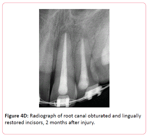 orthodontics-endodontics-root-canal-obturated