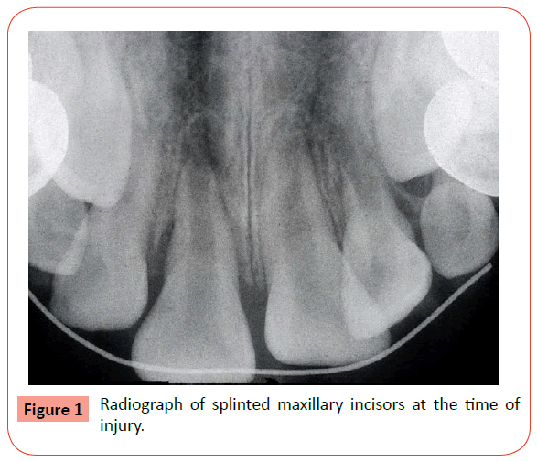 orthodontics-endodontics-splinted-maxillary-incisors
