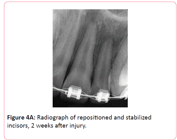 orthodontics-endodontics-stabilized-incisors