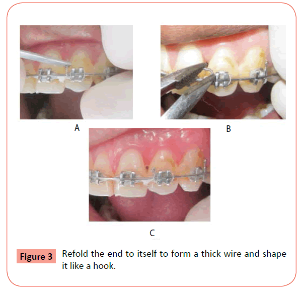 orthodontics-endodontics-thick-wire