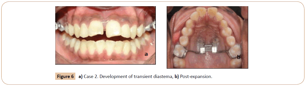 orthodontics-endodontics-transient-diastema