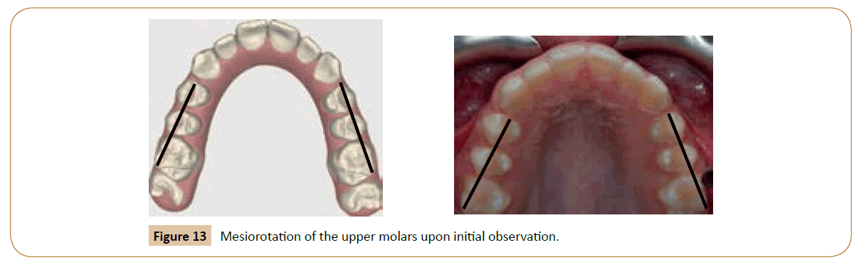 orthodontics-endodontics-upper-molars